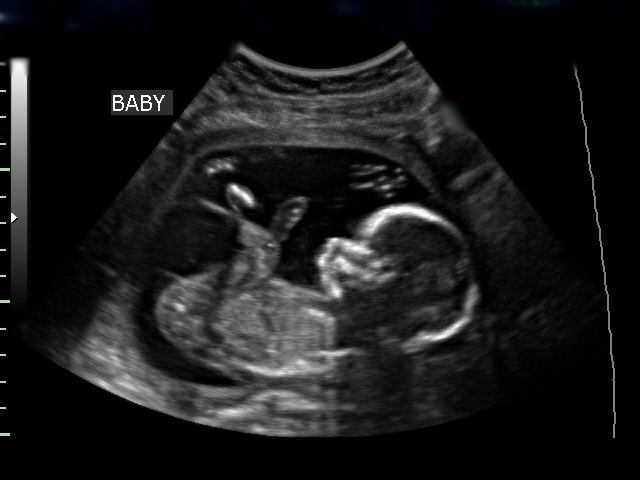 Baby Ultrasound Pictures 44